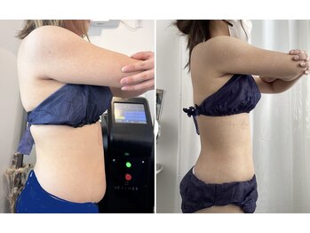 プレズィール(Plaisir)/2ヶ月のビフォーアフター