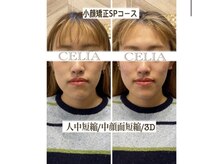 セリア(CELIA)/小顔矯正で垢抜け