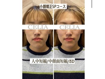 セリア(CELIA)/小顔矯正で垢抜け