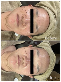 ジャスミン(Jasmin)/臍帯血幹細胞×NMN×AC-11