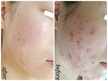 チューズコレクション(choose collection)/ハーバルピーリング