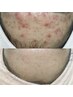 【ニキビケア専門】ニキビケア混合肌・脂性肌の方◎20,000→11,000