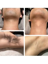 ラナンス 千早(LANUNCE)/髭&脇脱毛