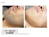 【男性★脱毛】メンズお顔脱毛コース（額から首まで全部）