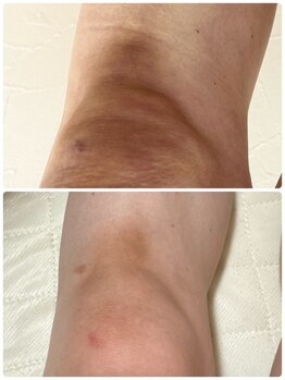 キュライム カブール町田店/膝や肘の黒ずみも!