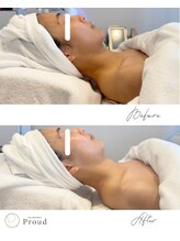 プラウド(Proud)/プラズマ/毛穴洗浄/１回での事例