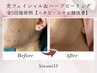 【繰り返すニキビ肌改善】フォト照射とヒト幹細胞ハーブピーリングダブルケア