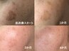 【都度払い】肌改善フェイシャル　90分