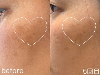 ハレオラ(HaleOla)/増えていく悩みにストップ!