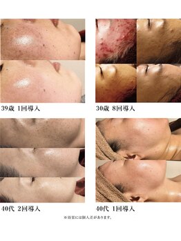 ミルジュ(MiLuJu)/ハーブ導入回数例シミニキビケア