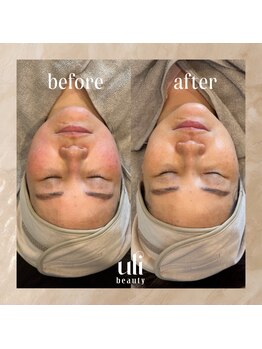 ウリ(uli beauty)/比較写真