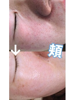 サロン リュンヌ(salon lune)/エクストラクション