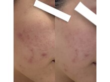 ワッカ(wacca)/【ヒト幹細胞】