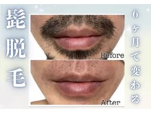 アルゴ 金沢増泉店(ALGO)/【メンズ髭脱毛】