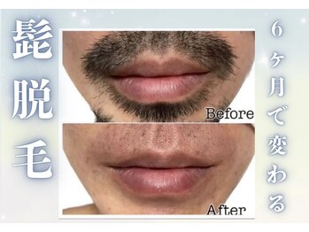 アルゴ 金沢増泉店(ALGO)/【メンズ髭脱毛】