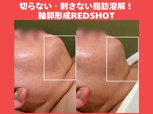 ポノ(Pono)の雰囲気（ダウンタイムなしで脂肪燃焼！憧れのフェイスラインに…☆）