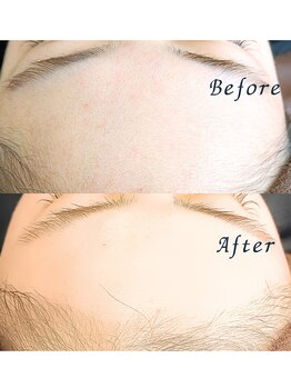 ララリア(LaLaLia)/フェイスWAX脱毛