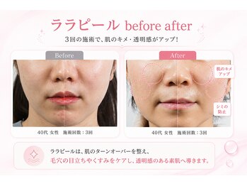 ポアラボ 佐久店(PORE LABO)/ララピール変化写真