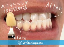 ホワイトニングカフェ 千葉店/ホワイトニング10回照射後＊男性