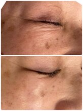 アリュール(ALLURE)/【艶肌Wax1回目の施術効果】