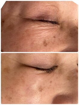 アリュール(ALLURE)/【艶肌Wax1回目の施術効果】