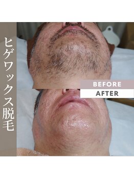 キナリ(kinari)/ヒゲワックス脱毛