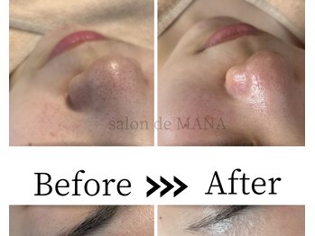サロンドマナ(salon de MANA)/毛穴徹底ケア!!