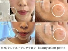 フェイシャル/マタニティ/シミしわケア/レモンボトル/ピーリング