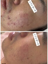 ヨノ(Yono)/エステ版ソフトダーマ