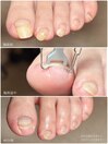 巻き爪改善ケア