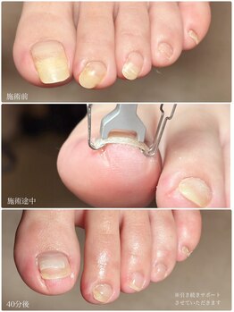 ディグニティ(Dignity)/巻き爪改善ケア