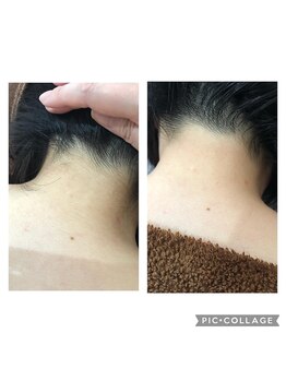 サロンシャイン(Salon Shine)/うなじ脱毛