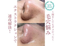 ダブル(W)