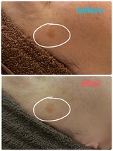 ギャラクシービューティー(galaxy beauty)/夏のシミケア