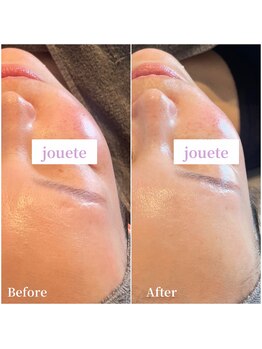 ジュエッテ(jouete)/第4世代ピーリング　ララピール