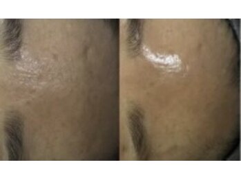 ブランシュ ギンザ(Blanche Ginza)/韓国水光3Dピール