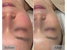 シェリーミル(Cherie Miru)/赤み/ざらつき/開き毛穴/くすみ