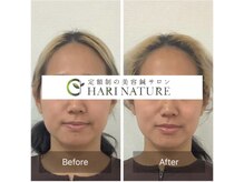 ハリナチュレ 梅田店(HARINATURE)/フェイスラインもスッキリ！