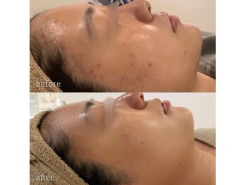 ニコリー(NICOLY)/ニキビケア症例