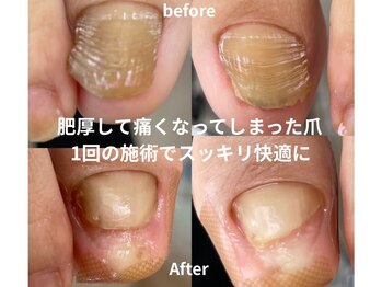 肥厚した爪のお悩み