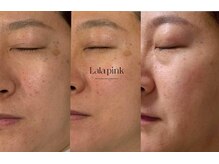 カルム(Calme)/Lalapink