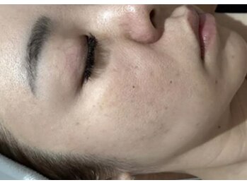 リベル 名古屋(Lebelle:)/栄　名古屋　ハーブピーリング