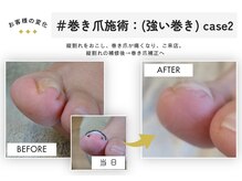 テネシー/＃巻き爪施術：(強い巻き) case2