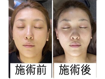 リベル(Liber)/痩身マシンエクシリス【全顔】