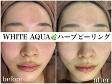 ホワイトアクア 天王寺本店(WHITE AQUA)/ハーブピーリングで赤ら顔も改善