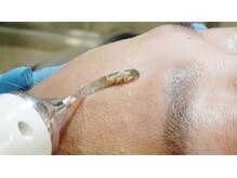 エステサロン 美飾り イオンモール木更津店/【ZEROピール】超音波で汚れ排出