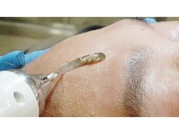 エステサロン 美飾り イオンモール木更津店/【ZEROピール】超音波で汚れ排出