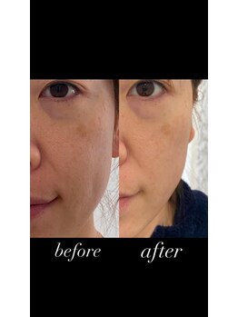 ミント(mint)/10億個のエクソソームを高配合