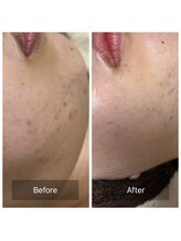 ビジュープラス 筑西下館店(Bijou+)/【30代お悩み】毛穴／10回6ヶ月