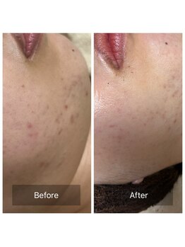 ビジュープラス 筑西下館店(Bijou+)/【30代お悩み】毛穴/10回6ヶ月